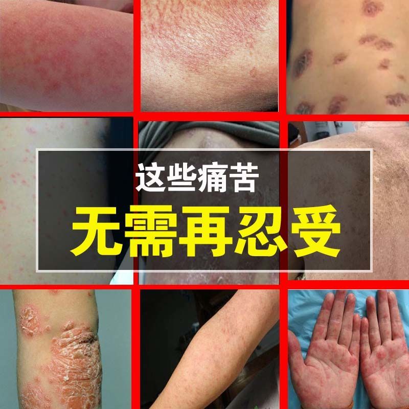 新品止痒膏皮肤瘙痒【药店同售】顽固皮肤症状反覆湿红痒过敏抑菌