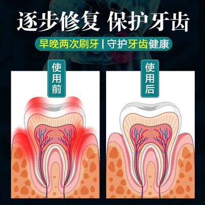 网红【牙松动不用拔】牙齿松动固齿牙膏牙龈肿痛出血牙齿修复固神