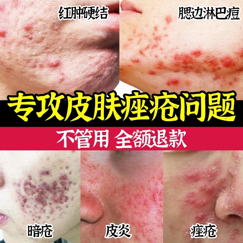 玫瑰青春痘膏祛痘重度暗疮药膏结节红肿硬块痘淋巴腮边消炎去痘印