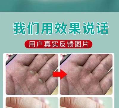 推荐云南本草汗泡珍汗泡疱疹药膏汉汗状手上小水泡专用软膏汗孢疹