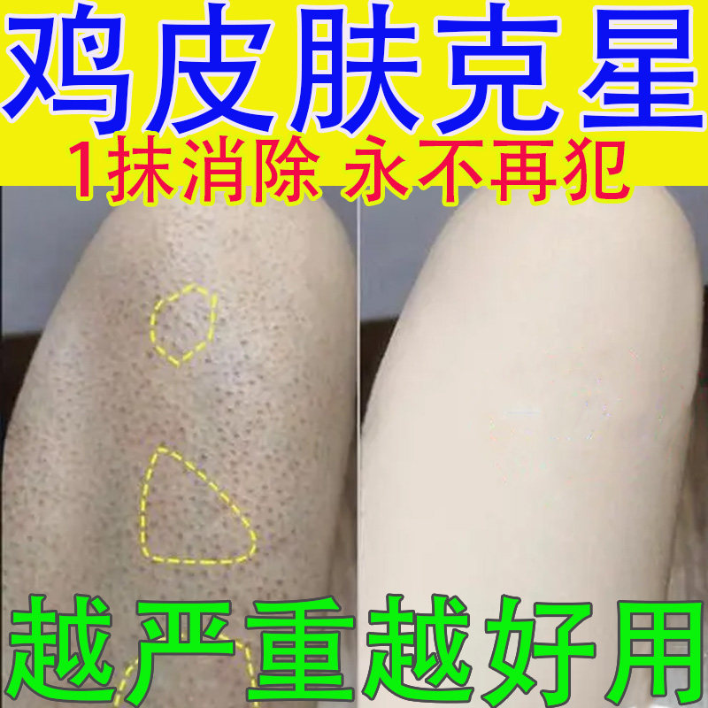 速发治鸡皮肤鸡皮疙瘩皮肤淀粉样变全身鱼鳞蛇皮毛囊角化症橘皮脸