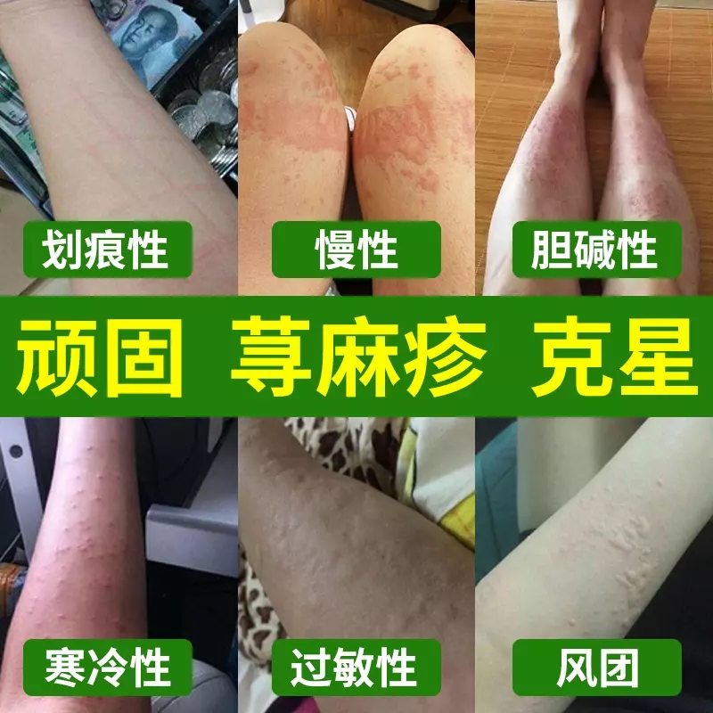 极速治急慢性寻荨麻疹过敏止痒风团划痕胆碱皮肤瘙痒麻疹专用药膏