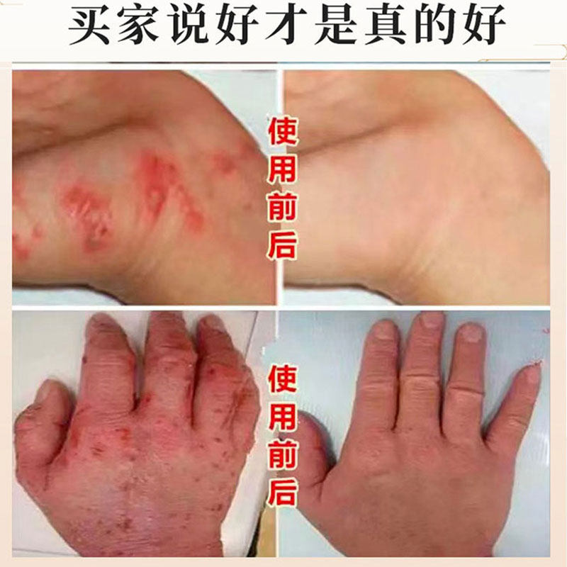 速发汗状泡疹专用软膏手上起小水泡汉状孢手痒脱皮止痒真菌感染手