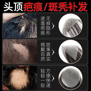 疤痕补发贴头顶秃斑伤痕秃顶专用假发贴片真人发丝生物头皮男女片