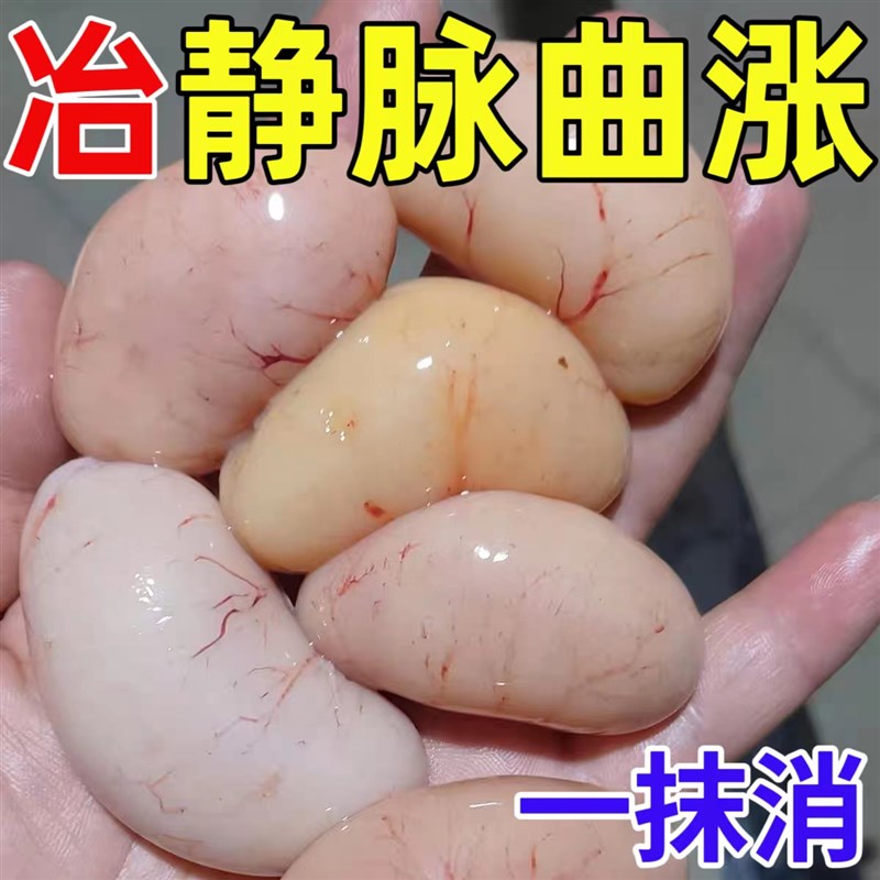 热销【美国技术冶曲张】静脉曲涨特效膏抹平凸起青筋老烂腿冷敷凝
