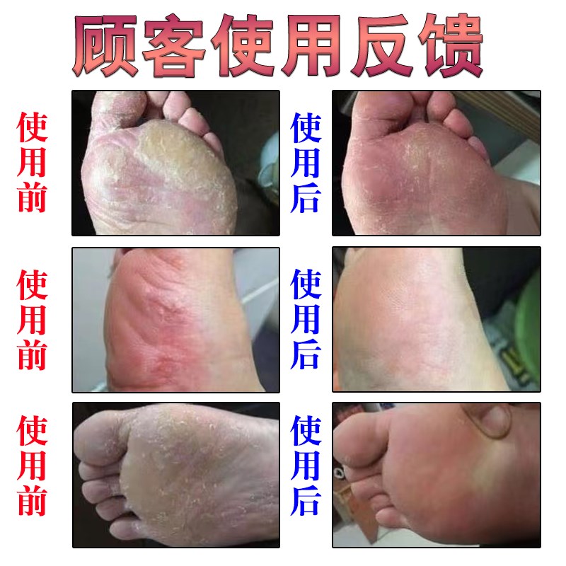 热销治汗脚脚臭喷雾根冶脚酸脚痒水泡脱皮烂脚丫沙虫脚除臭止汗药