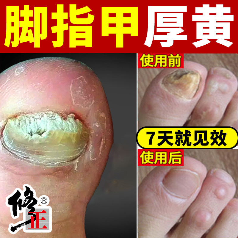 热销修正脚趾甲发黄变厚变硬坏指甲增厚空甲黑白修复甲肉分离黑专