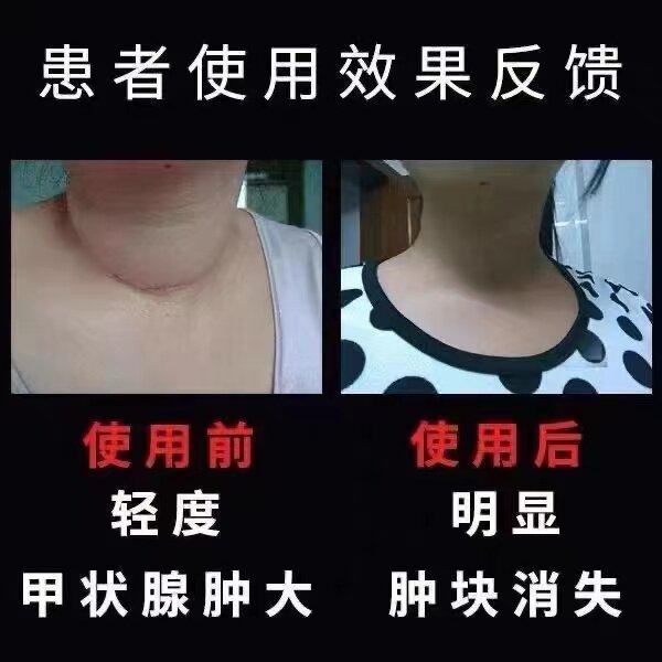 速发稳定碘抗辐射普鲁士蓝药试剂 甲状腺肿大 甲状腺粗专科用膏fc