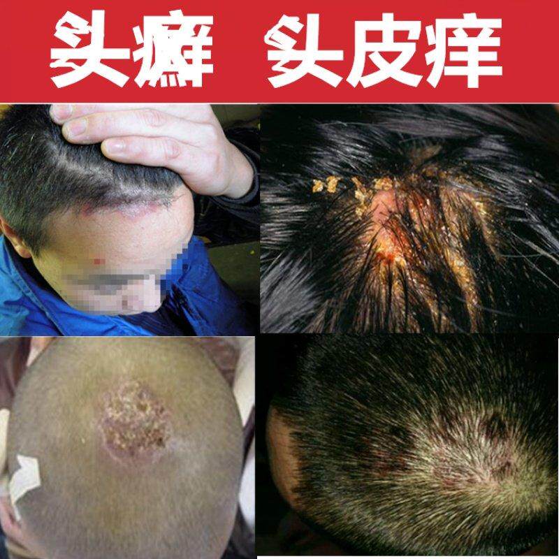现货速发治头藓的药膏头皮藓头皮痒大块头皮屑毛囊红痒真菌起疙瘩