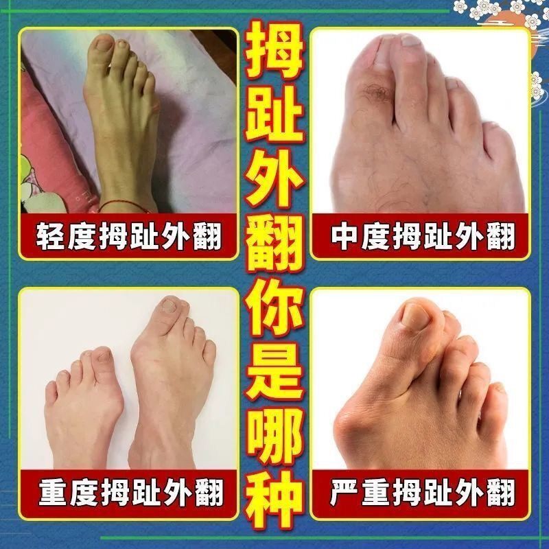 热销【重症外翻】拇指外翻矫正神器大脚骨变形脚趾重叠关节疼专用