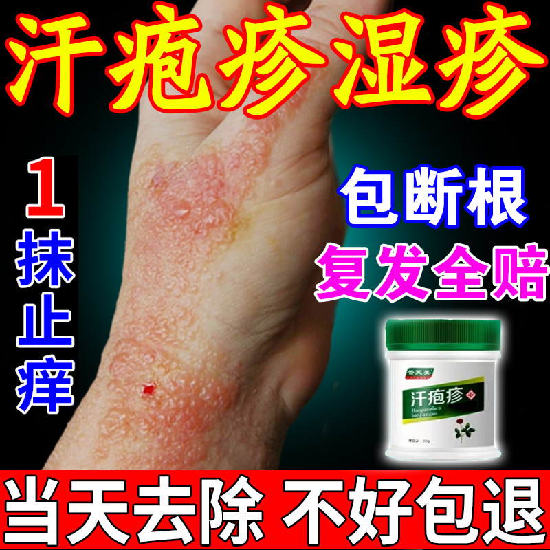 汗泡药膏儿童手上起小水泡状湿疹止痒脱皮手足癣真菌感染软膏