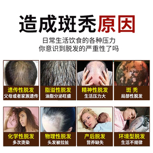 脱发严重男专用儿童女士脂溢性防脱鬼剃发药斑秃生髪液中药调 新品