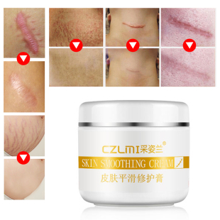 Removal Stretch Face Pimples Cream Marks 推荐 Remov Scar