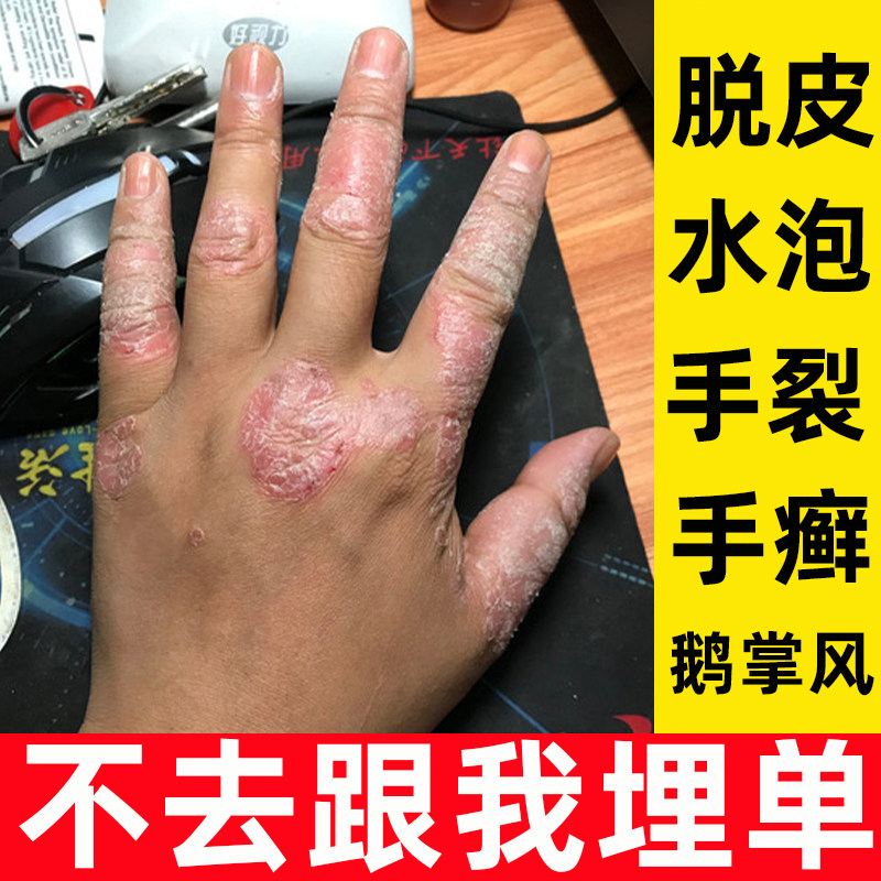 手脱皮膏汗疱藓的膏真菌感染手干裂蜕皮鹅风掌治手裂疹膏