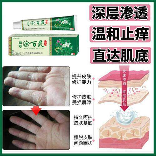 痒心汗疱疹手手湿泡起水疹汗疱疹膏手掌干裂治手裂手足癣鹅掌风