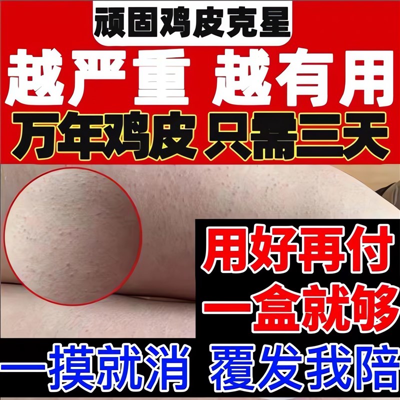 鸡皮肤疙瘩药膏手臂大腿胳膊脸部毛囊角化毛孔堵塞去除神器男女霜