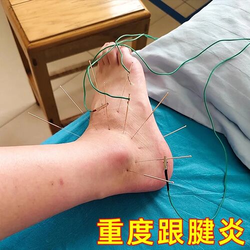 【8辈子不再犯】足跟疼痛神器治脚后跟疼足底筋膜痛跟腱疼专用膏