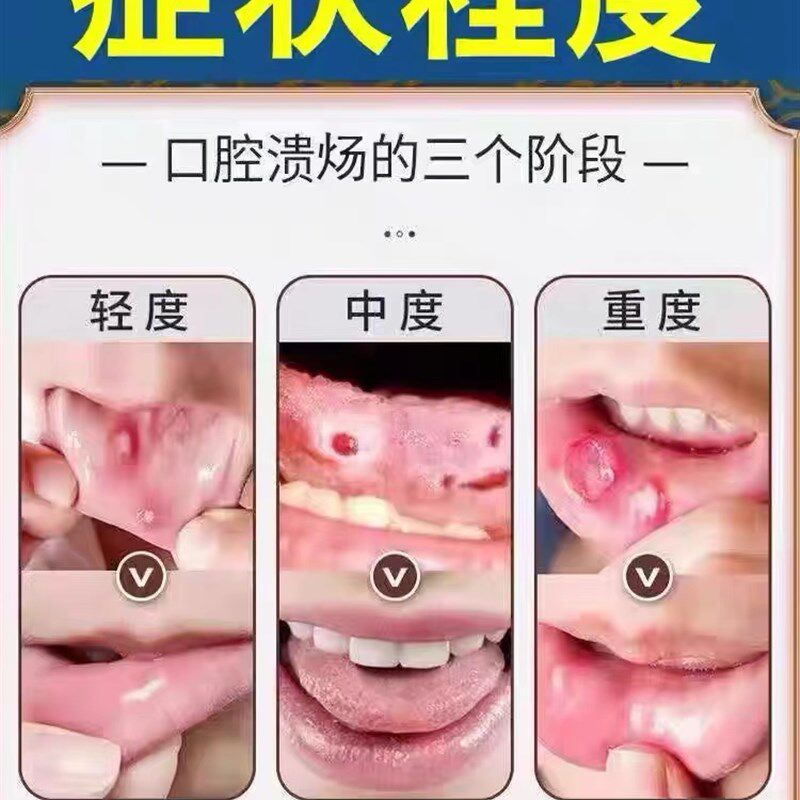 【当晚秒见校】口腔溃//疡专用修复喷剂嘴巴起泡上火钻心疼特校药