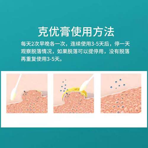 现货怀堂清尤灵疣宁品托r冷凝胶克疣霜液仙嗳扁平克疣膏正官敷方