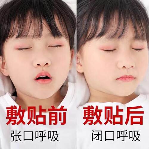 工厂销腺b样体肥大调理面容矫正器儿童宝宝睡觉张嘴呼吸鼻塞不通
