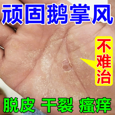 手癣膏真菌感染手部鹅掌风手足癣干裂脱皮瘙痒粗糙汗疱疹专用药膏