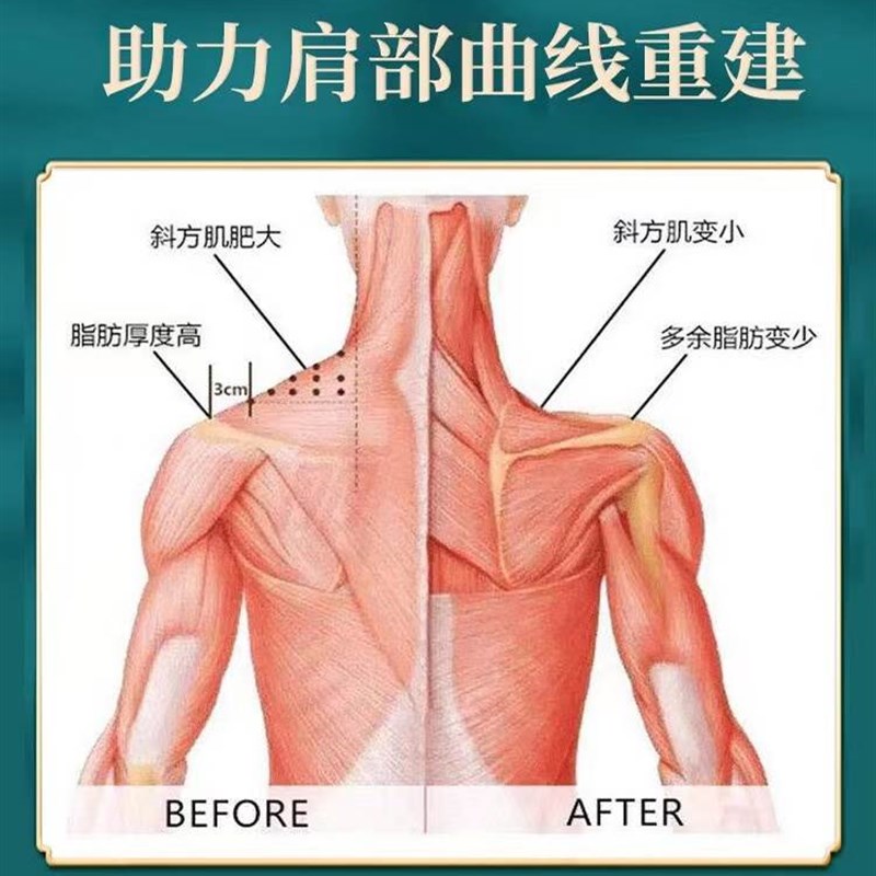 速发斜方肌消除神器美肩神器瘦肩薄背女神远离肉厚直角肩膀贴.