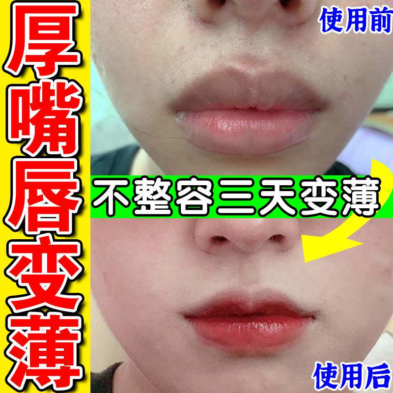 速发嘴唇变薄变小改善凸嘴厚唇变薄缩小香肠嘴唇外翻瘦唇嘴突矫正