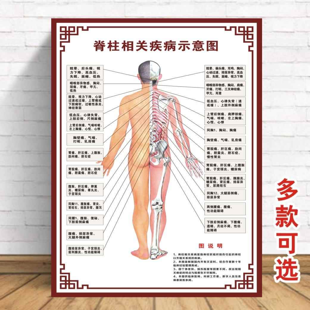 脊柱相关疾病示意图医院脊椎大挂图人体经络穴位大挂图中医养生图