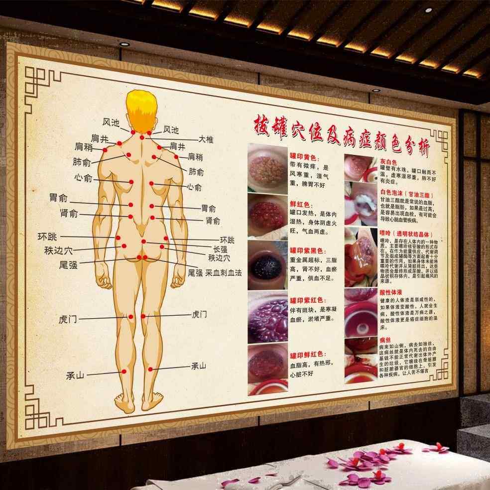 拔罐穴位及病症颜色海报广告宣传装饰画壁画拔罐印对应症状挂图