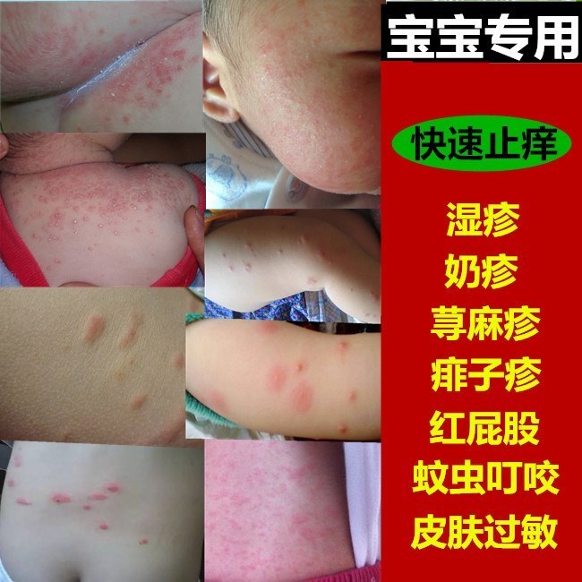 儿童寻麻荨疹过敏止痒断根宝宝湿疹婴儿奶癣蚊虫叮咬皮炎外用药膏