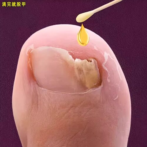 【屈臣氏热卖】滴一滴 不脱甲 祛除99%灰钾真菌 无效可褪！！
