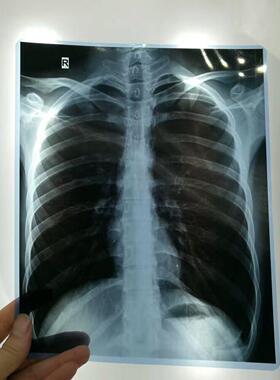 新型高清蓝基 激光蓝片干式CT DR CR X光MR核磁共振医用胶片打印