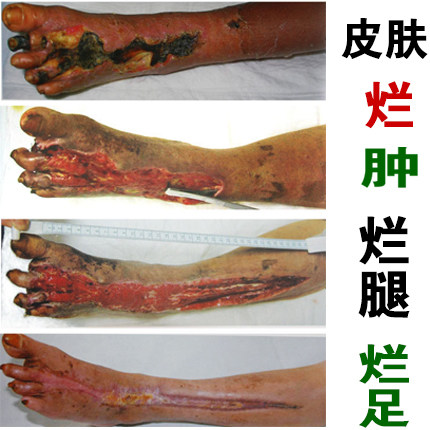 祛腐生肌长皮长肉膏糖尿病足烂足手老烂腿褥疮烂疮皮肤溃烂外伤