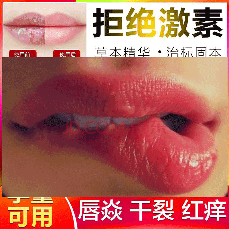 口唇炎唇膏修复药用软膏嘴唇干裂脱皮起皮上火起水泡烂嘴角润唇油