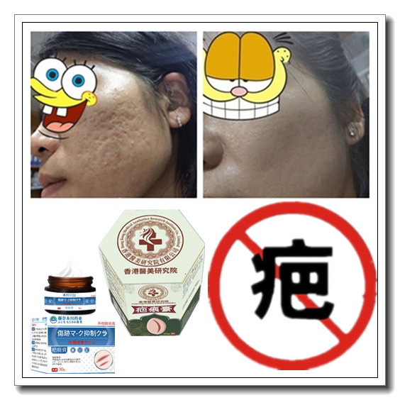 消除增生性烟烫软化凸疤冻疮疙瘩去缝针手术产后开刀色素巴痕灵药