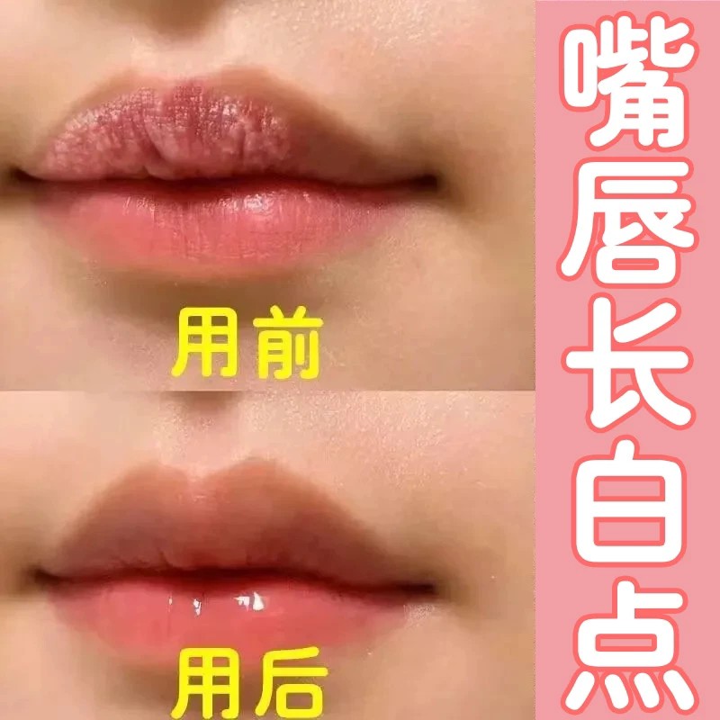 皮脂腺异位症嘴唇起白点小颗粒抑菌专用唇炎干裂脱皮脂肪粒起泡