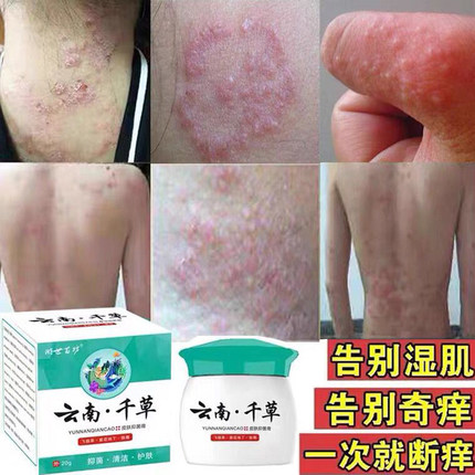 湿疹止痒祛根湿毒清皮肤瘙痒抑菌全身痒外用狼毒软膏云南千草正品