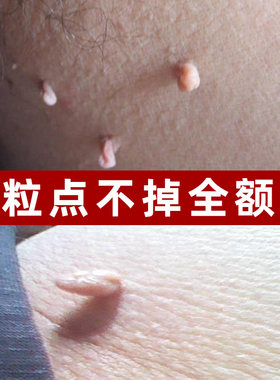 南京同仁堂扁平疣腋下丝状脖子上长肉粒瘊子疙瘩神器