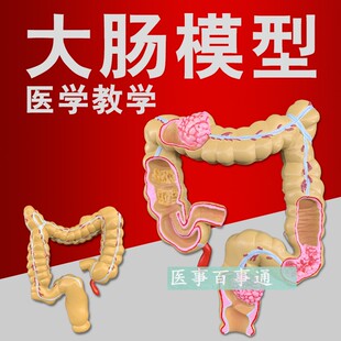 人体结肠病变模型 大肠模型 大肠病态内脏 消化科教具 盲肠阑尾