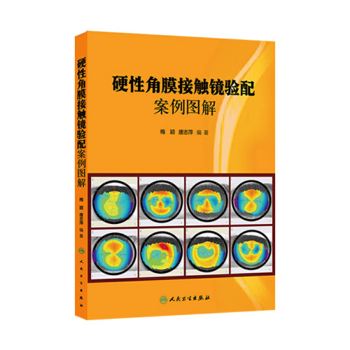 硬性角膜接触镜验配案例图解