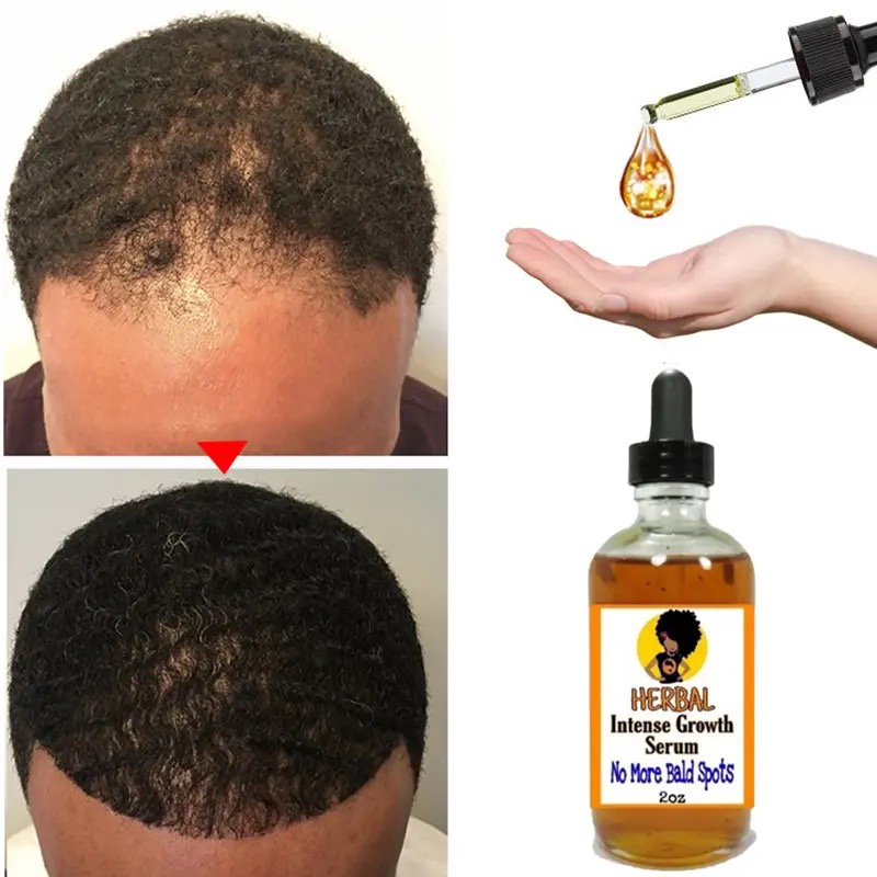 HERBAL Black Seed Castor Oil Hair Growth Serum Fast Growth