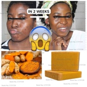 Soap Dark Natural Tumeric Lightening Acne Spots Brighter