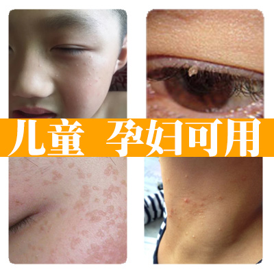 特效去除面部扁平尤丝状尤肉粒软疣传染性 儿童病毒软疣水瘊子