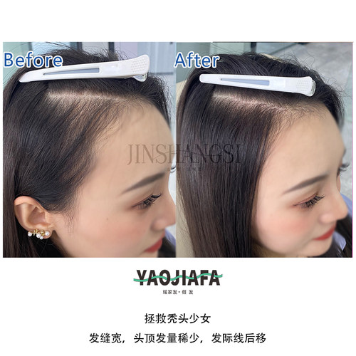物理轻增发解决头发稀少头顶稀疏