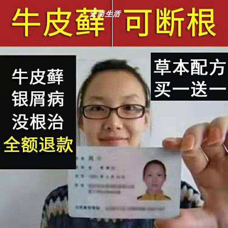 苗家药牛皮癣外用祛癣专用皮肤癣药膏去除股体藓止痒特效汗疱疹