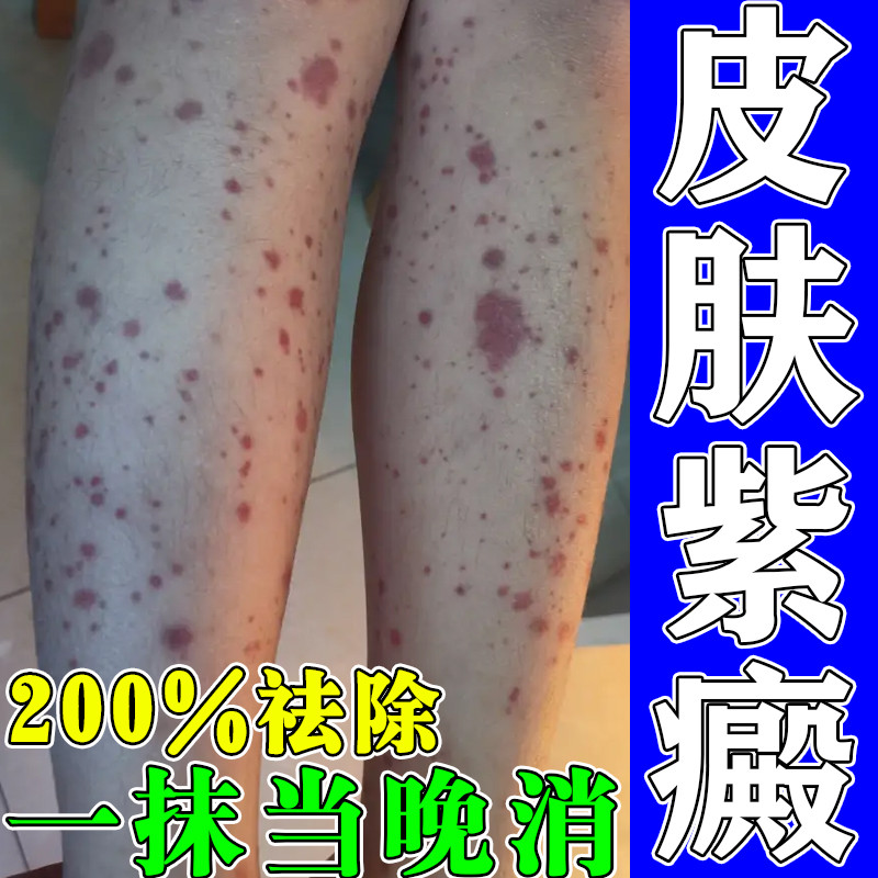 祛除色素过敏性紫癜治疗皮下出血紫癜色素沉淀皮炎血管炎淡化克星