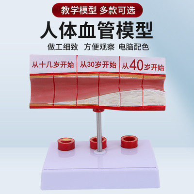 血栓模型人体支脉粥样硬化动脉心血管各阶段年龄血管展示模型