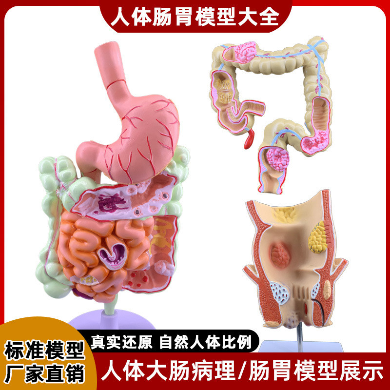 人体大肠病理模型 肠胃解剖模型 病态大肠盲肠 直肠 十二指肠模型