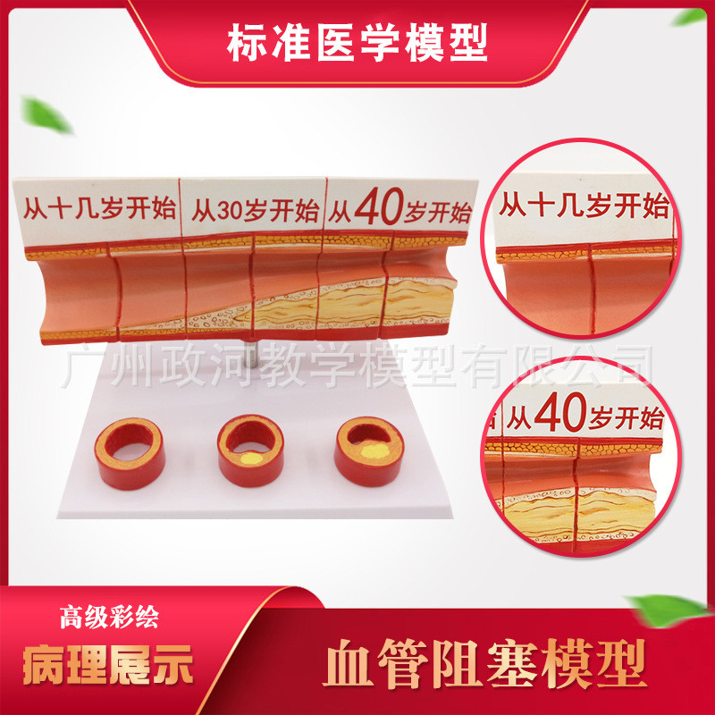 血栓模型 人体支脉粥样 心血管动mai硬化 各阶段年龄血管展示模型