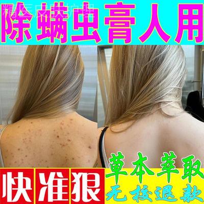 治螨虫的药膏祛螨除痘虱疮人用背上长痘痘前胸后背止痒专用神器